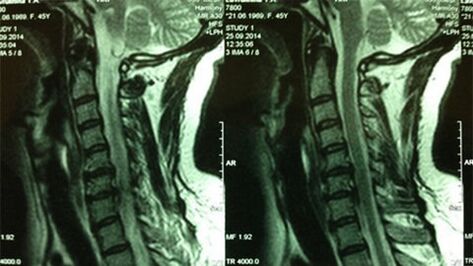 Արգանդի վզիկի բաժնի MRI